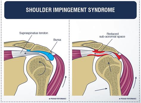 How To Fix Shoulder Pain Impingement 5 Easy Steps At Lola Raffa Blog