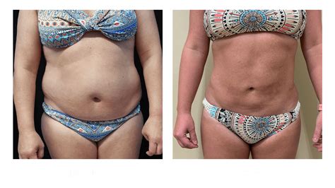 Tummy Tuck And Liposuction