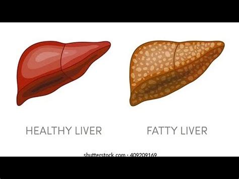 What Is Hepatic Steatosis Disease Fatty Liver Liver Youtube