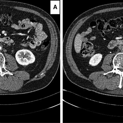 Computed Tomography Angiography Cta Images Illustrating The