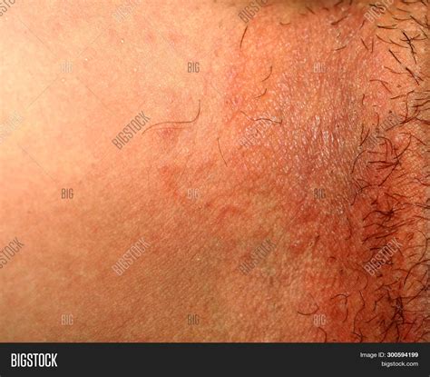 Fungal Infection Groin Image And Photo Free Trial Bigstock