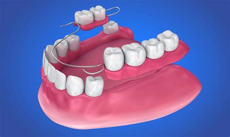 Complete And Partial Dentures Amelia Perfect Smile