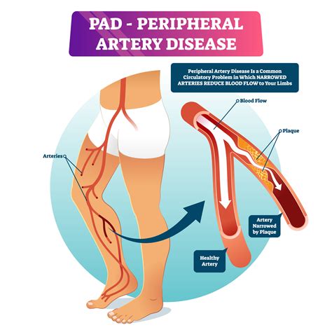 Peripheral Artery Disease Symptoms And Mds Best Treatments Comfort