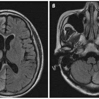 Fluid Attenuated Inversion Recovery Magnetic Resonance Imaging After 1