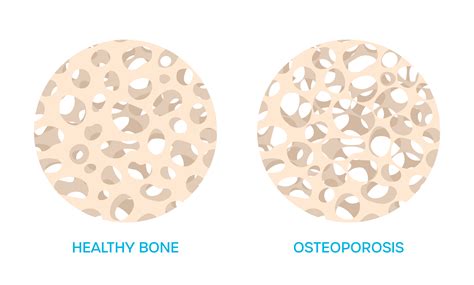 AVALA NOW PROVIDING THE LATEST IN BONE HEALTH ASSESSMENTS - AVALA