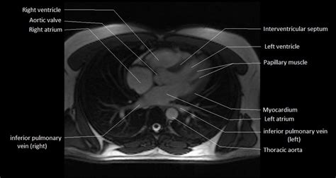 MRI Anatomy of Heart | Free MRI Axial Heart Cross Sectional Anatomy