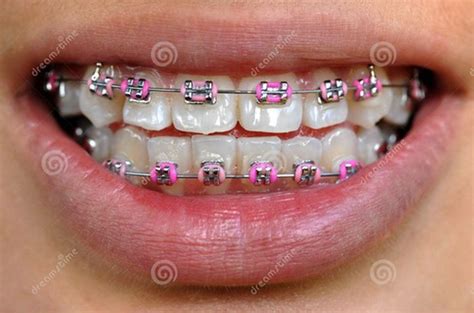 Hot Pink Braces Colors Braces Pinterest Hot Pink Pink Braces And