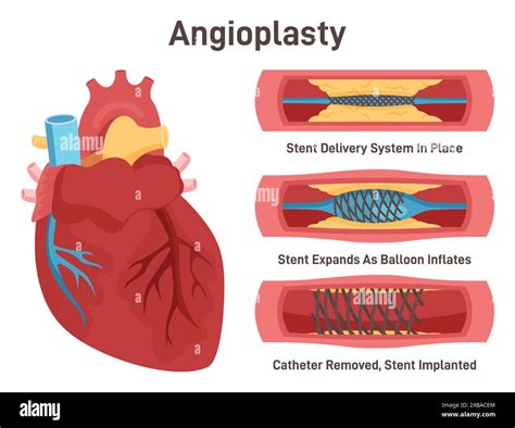 Angioplasty Stent Delivery And Implantation Deflated Balloon Catheter