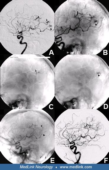 Presurgical Embolization Of Tumors Of The Brain Head And Neck And