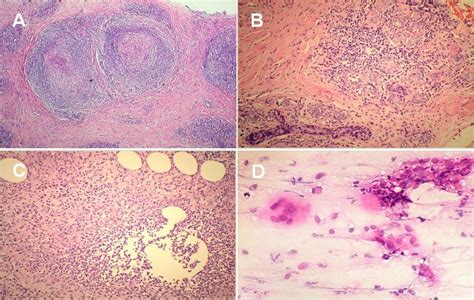 Figure Granulomatous Mastitis Evident Granulomas In A Breast Tissue