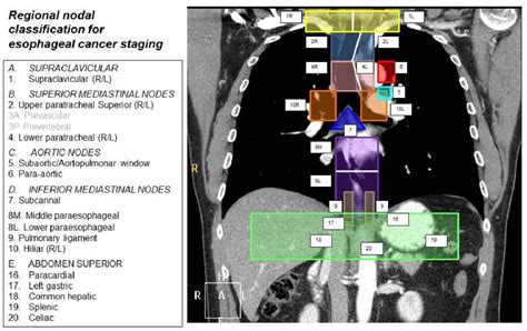 Figure 2 From Esophageal Cancer Anatomical Features Current