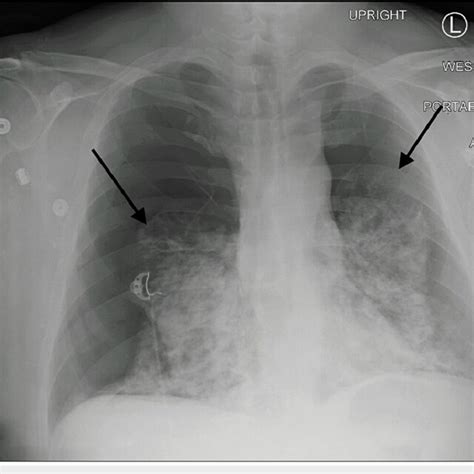 Chest X Ray Spontaneous Bilateral Pneumothorax With Severe Airspace