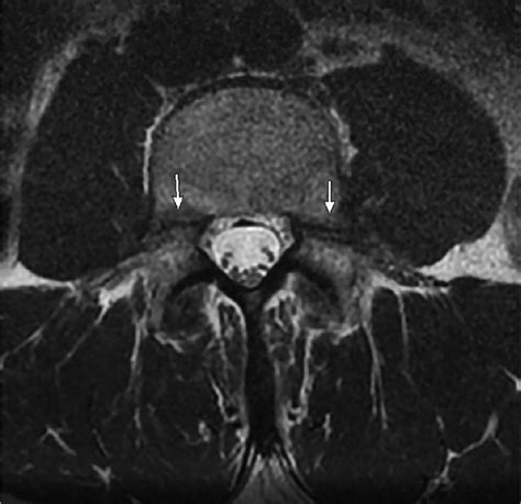 Axial T2 Weighted MRI Of L4 Depicting Bilateral Pedicle Fractures