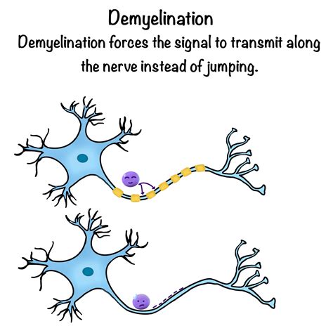 What Is Demyelination Web Illustration ICORD