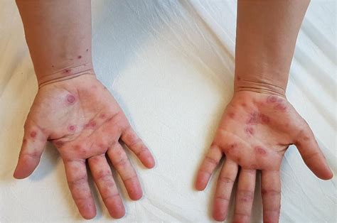 Erythema Multiforme Minor Hand