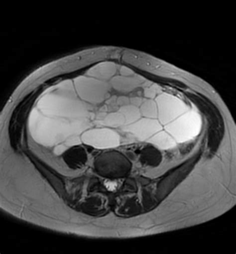 Mucinous Cystadenoma Ovary