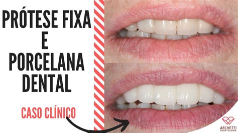 Prótese fixa e Porcelana Dental Antes e Depois Caso clínico YouTube