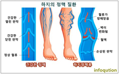 하지정맥류 초기증상 원인 자가진단 치료 병원 수술비 예방법