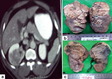 A Ct Scan Of The Abdomen Showing A Heterogeneously Enhancing Mass