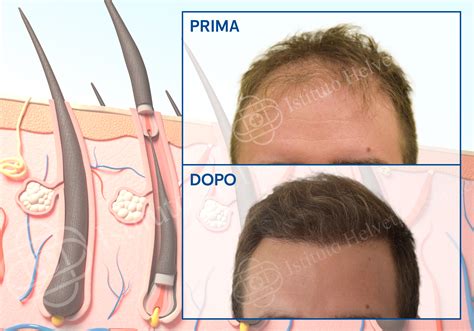 Trapianto Di Capelli Limportanza Di Monitorare La Corretta Ricrescita