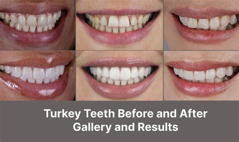 Turkey Teeth Before And After Findglob