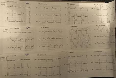 Dr. Smith's ECG Blog: Incredible case of evolution of terminal QRS distortion, then resolution ...