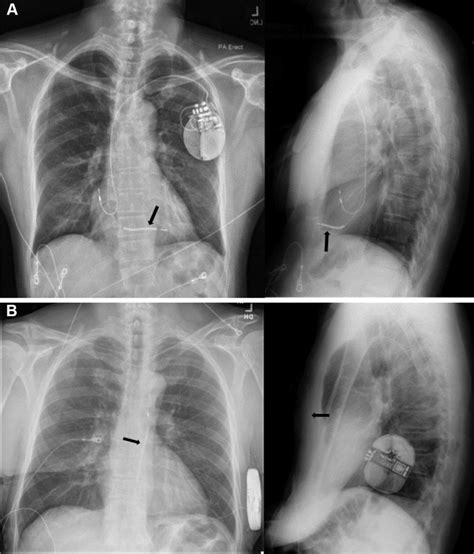 A Is A Posteroanterior And Lateral Chest X Ray Of A Patient With A Dual