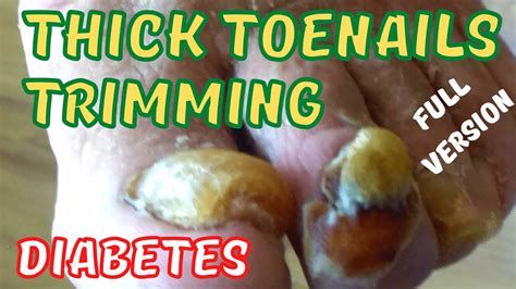 Yellow Thick Toenails Trimming Diabetes Youtube