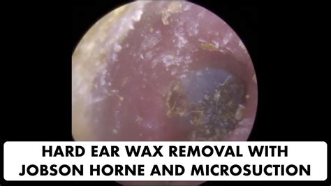 Hard Ear Wax Removal With Jobson Horne And Microsuction Youtube