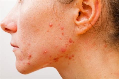 Principais Tipos De Acne E O Que Fazer Tua Sa De