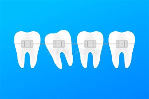 Correction Of Teeth With Orthodontic Braces Stages Of Teeth Alignment