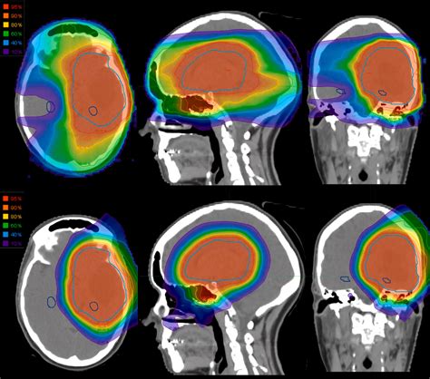 Treatment Plan Comparison Of Proton Vs Photon Radiotherapy For Lower Grade Gliomas Physics And