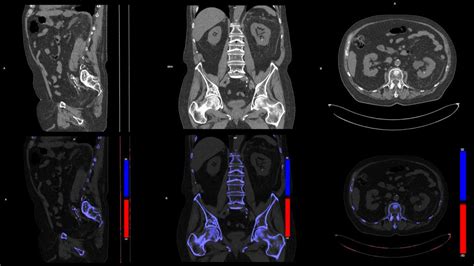 Dual Energy Ct Spectral Imaging Siemens Healthineers Usa