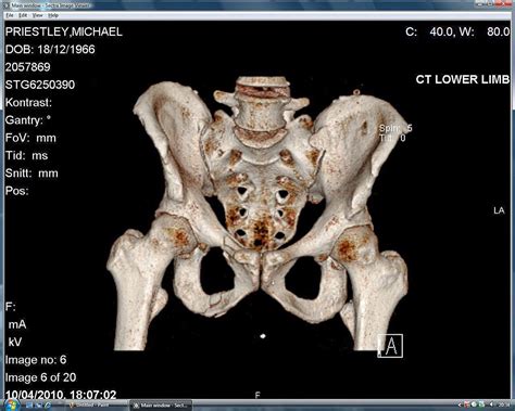 3d Ct Scan Front 3d Ct Scan Of My Triple Pelvis Fracture… Flickr