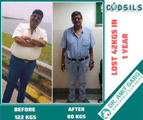 Bariatric Surgery Results Success Stories Dr Amit Garg