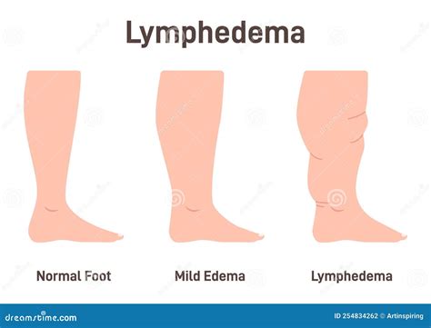 Lymphedema Stages. Lymphatic System Dysfunction Disease Stock Vector ...