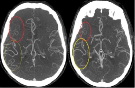 Single Phase Computed Tomography Angiography Demonstrating Posterior Download Scientific