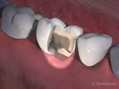 Chipped Molar Tooth - Dental News Network