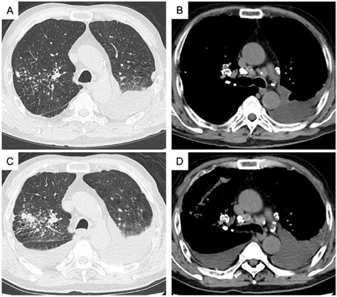 A B And C D Are Chest Computed Tomography Ct Images Acquired At Download Scientific