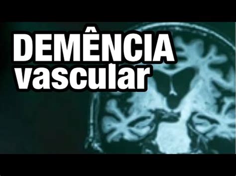 Dem Ncia Vascular Sintomas Diagn Stico E Tratamento Youtube