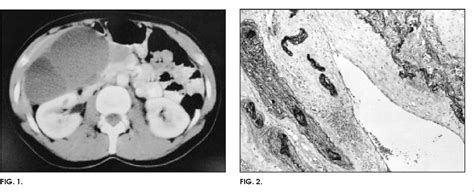 Figure 1 From Soft Tissue Images Retroperitoneal Venous Angioma