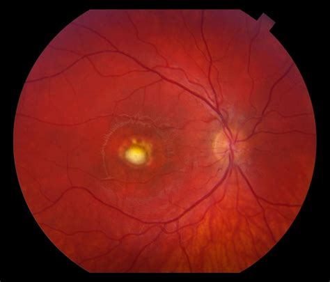 Moran CORE | Fundus photo and OCT of Best’s vitelliform macular ...