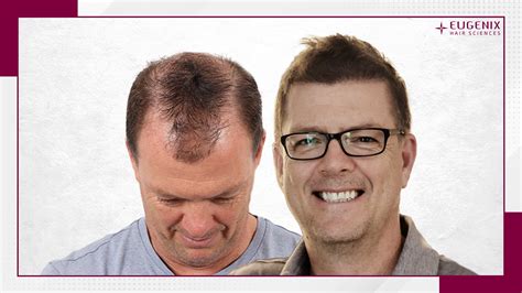 Hair Transplant Cost Per Graft Hair Transplant Cost In India Eugenix