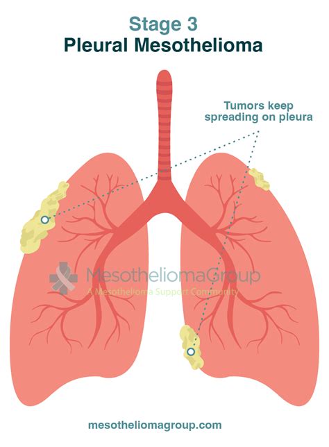 Mesothelioma Stages Breaking Down The Stages