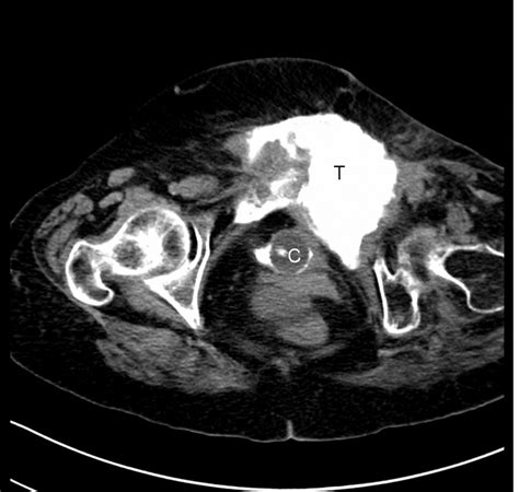 Bladder Fistula Repair