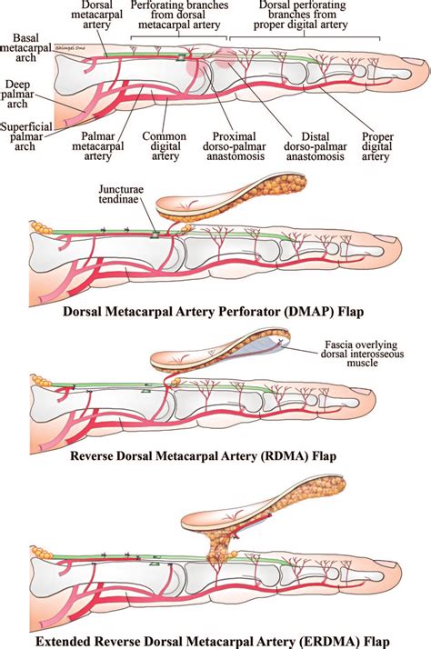 Illustration Depicting The Vascular Basis Of Flaps Raised From The