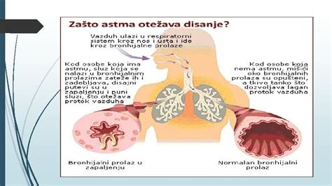 BRONHIJALNA ASTMA KOD DJECE Dr Sci Me UranoviMilii