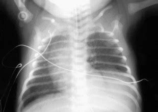 Postnatal Spontaneous Resolution Of Congenital Cystic Adenomatoid