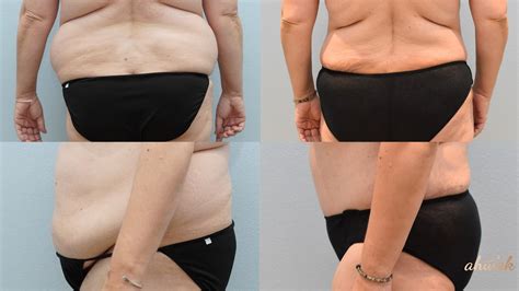 Tummy Tuck In Turkey A Comprehensive Guide With Ahwak