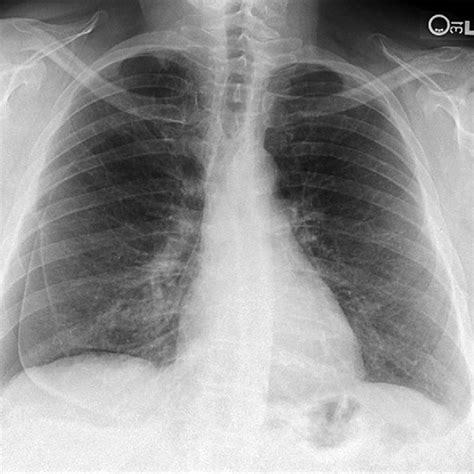 Posteroanterior Chest Radiograph Download Scientific Diagram